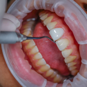 Resin Veneers