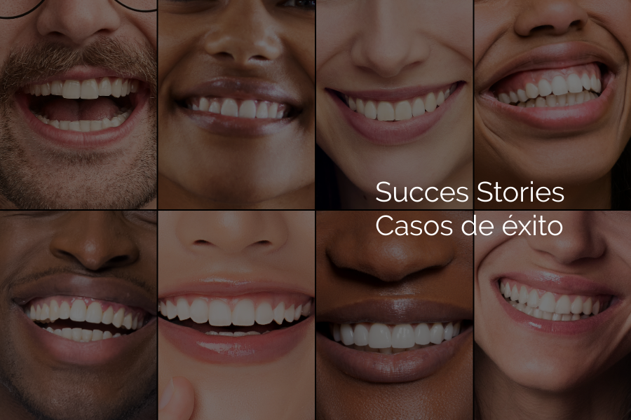 Success Stories, Dr. Gonzaga Tabares: Transformations with Porcelain and Resin Veneers and Custom Designs. Smiles That Change Lives. / Casos de éxito del Dr. Gonzaga Tabares: carillas de porcelana, resina y diseño personalizado. Sonrisas que cambian vidas en Cali y Punta Cana.